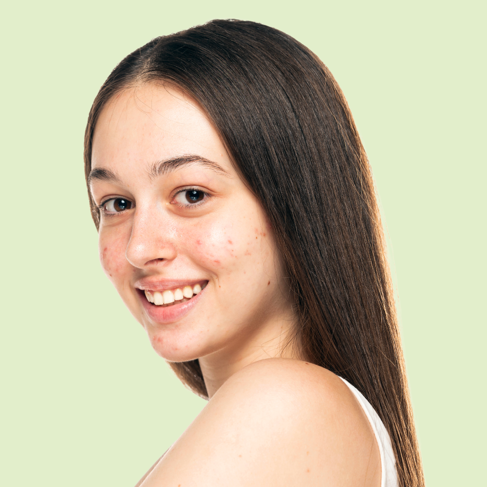 A photo of a person teenage girl with acne